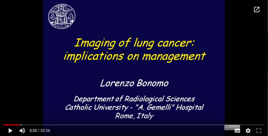 Imaging of lung cancer: Implications on management  (2016)