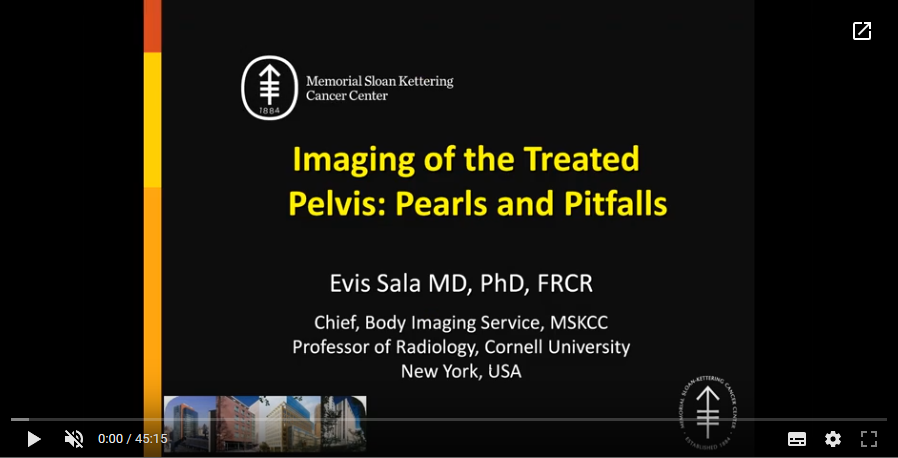 Imaging of the treated pelvis: Pearls and pitfalls (2017)